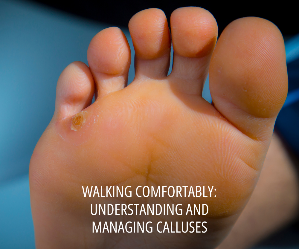 Walking Comfortably: Understanding and Managing Calluses